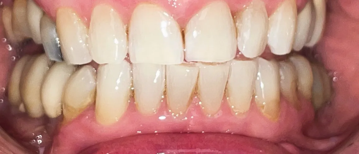 Dopo il trattamento: denti più chiari e allineati