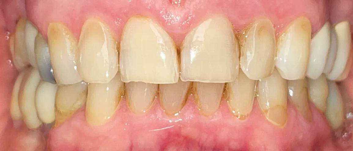 Prima del trattamento: denti ingialliti